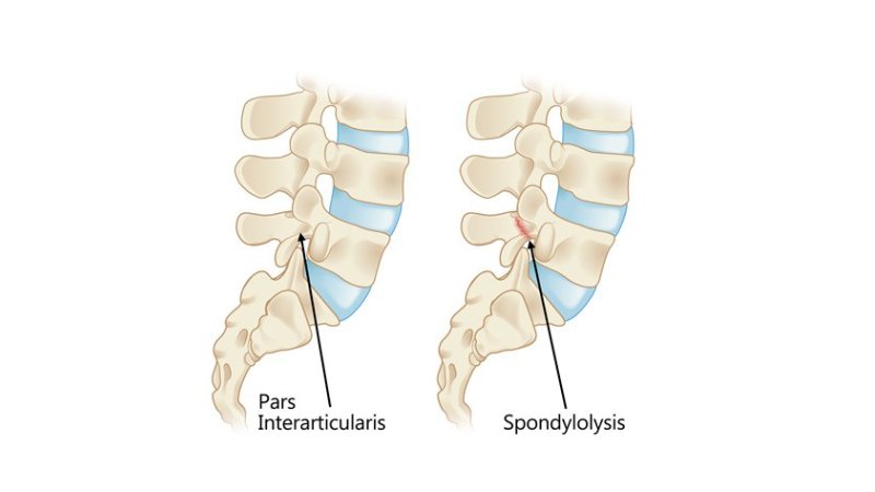 Spondylosis Treatment