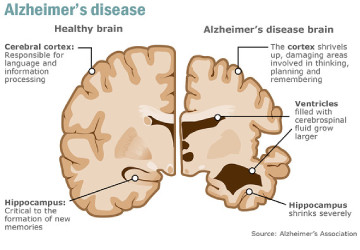 alzheimer-disease