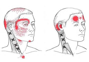 cervicogenic-headache