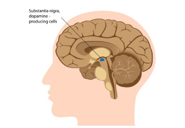 parkinson disease