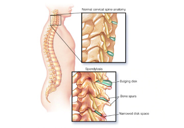 spondylosis