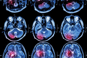 Read more about the article What causes stroke disease and what are the types of strokes?