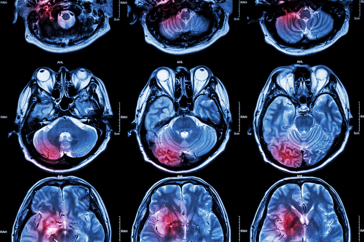 You are currently viewing What causes stroke disease and what are the types of strokes?