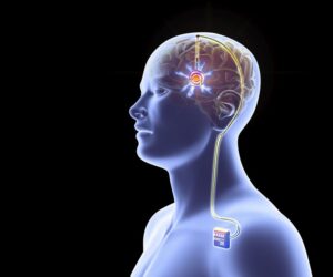Read more about the article Deep Brain Stimulation | Goelneuro