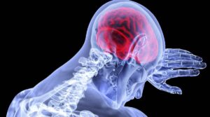 Read more about the article Stroke Awareness Cause and Myths