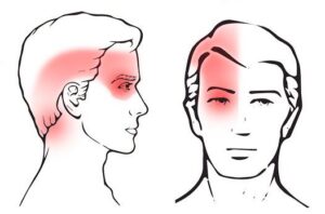 Read more about the article What Is Cervicogenic Headache.