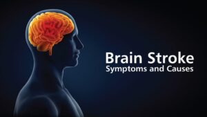 Read more about the article A stroke is a brain injury caused by a disruption of blood flow to the brain